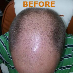 Hair Restoration by NeoGraft® Before & After Image