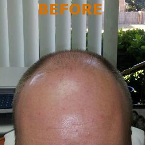 Hair Restoration by NeoGraft® Before & After Image