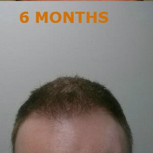 Hair Restoration by NeoGraft® Before & After Image