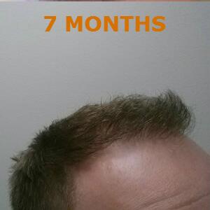 Hair Restoration by NeoGraft® Before & After Image