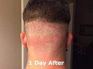 Hair Restoration by NeoGraft® Before & After Image