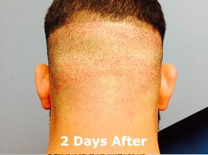 Hair Restoration by NeoGraft® Before & After Image