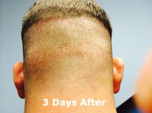 Hair Restoration by NeoGraft® Before & After Image