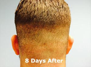 Hair Restoration by NeoGraft® Before & After Image