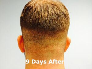 Hair Restoration by NeoGraft® Before & After Image