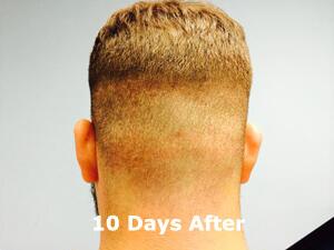 Hair Restoration by NeoGraft® Before & After Image