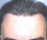 Hair Restoration by NeoGraft® Before & After Image