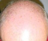Hair Restoration by NeoGraft® Before & After Image