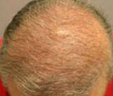 Hair Restoration by NeoGraft® Before & After Image