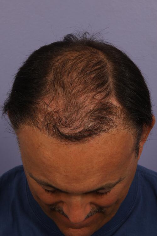 Hair Restoration by NeoGraft® Before & After Image