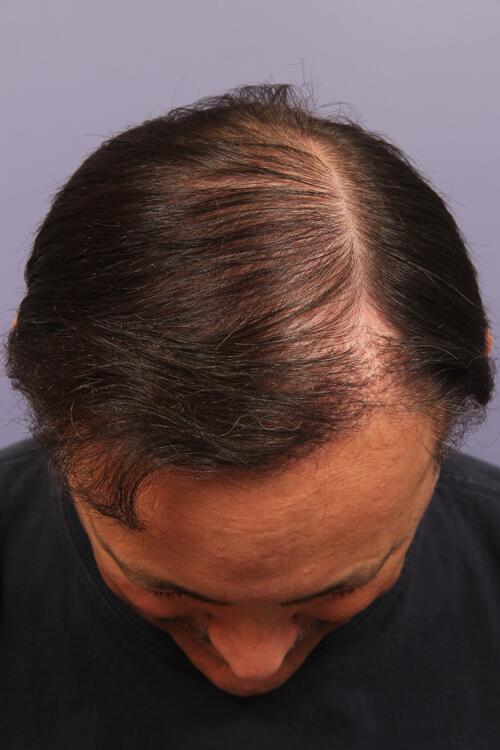 Hair Restoration by NeoGraft® Before & After Image