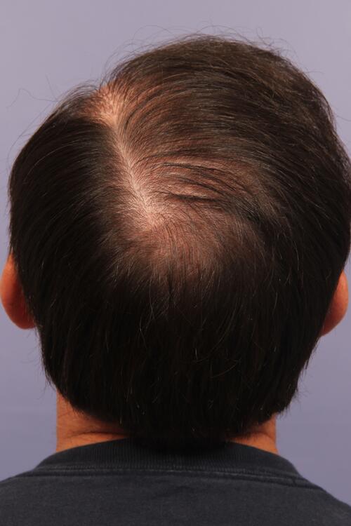 Hair Restoration by NeoGraft® Before & After Image