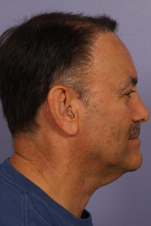 Hair Restoration by NeoGraft® Before & After Image