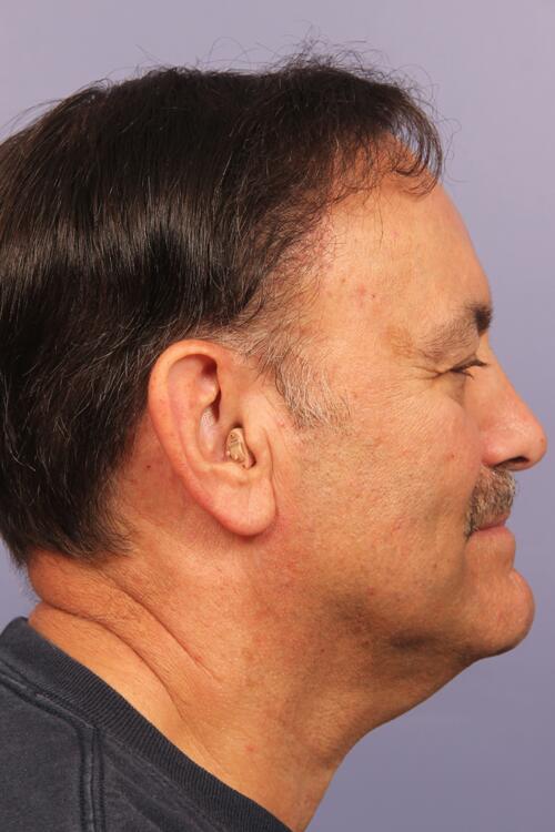 Hair Restoration by NeoGraft® Before & After Image