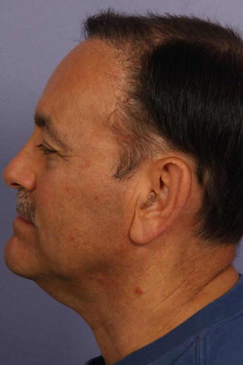 Hair Restoration by NeoGraft® Before & After Image