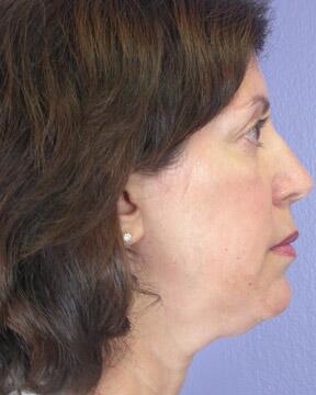 Injectable Fillers Before & After Image