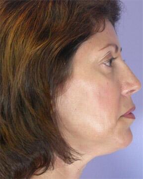 Injectable Fillers Before & After Image