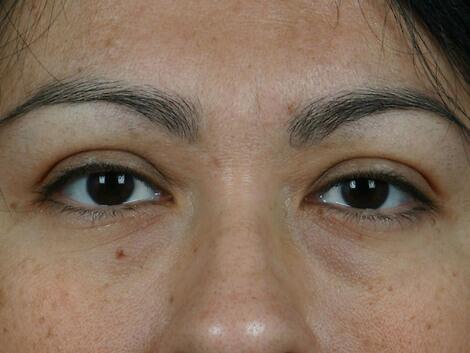 Injectable Fillers Before & After Image