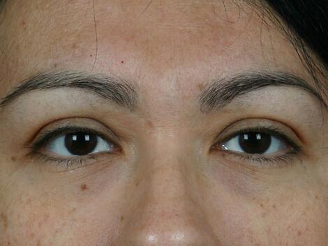 Injectable Fillers Before & After Image