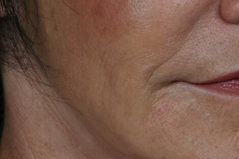 Injectable Fillers Before & After Image