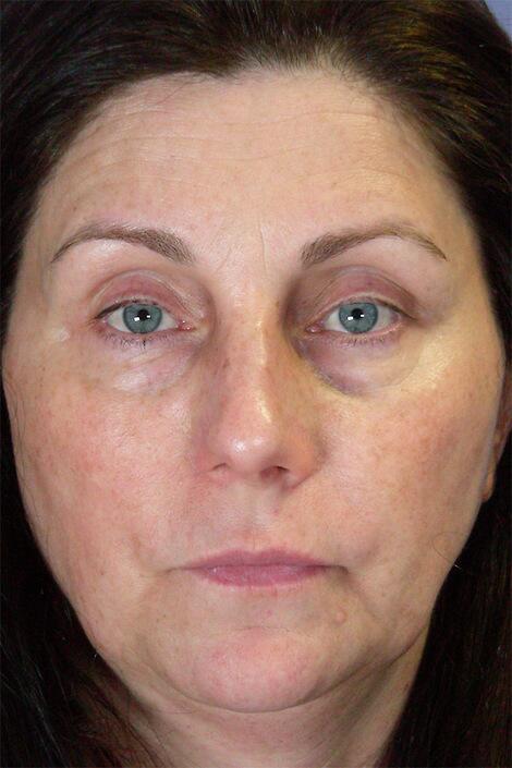 Injectable Fillers Before & After Image