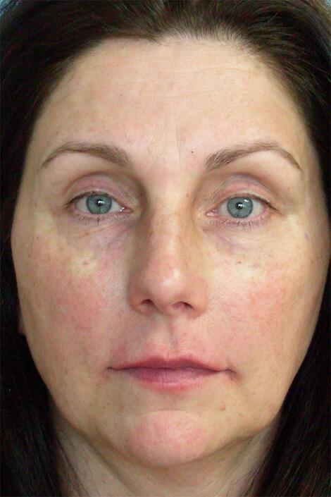 Injectable Fillers Before & After Image