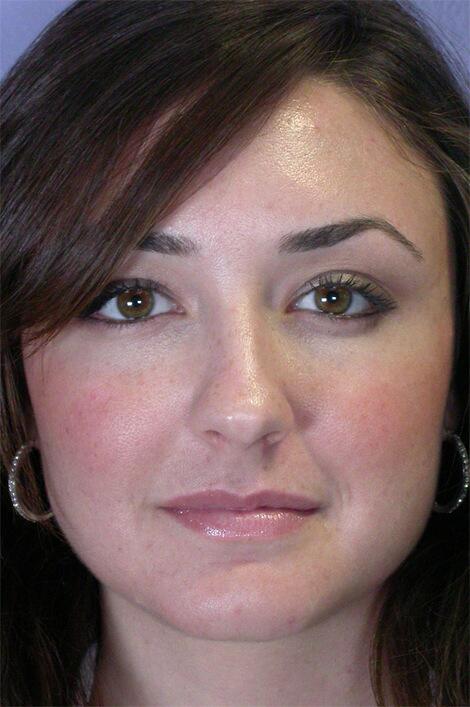 Injectable Fillers Before & After Image