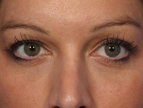 Injectable Fillers Before & After Image