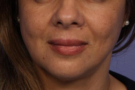 Injectable Fillers Before & After Image