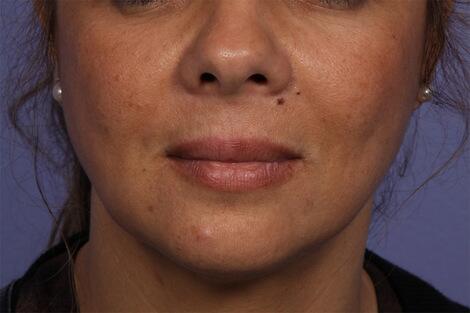 Injectable Fillers Before & After Image