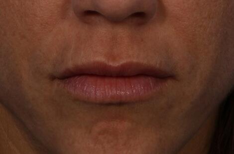 Injectable Fillers Before & After Image