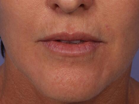 Injectable Fillers Before & After Image