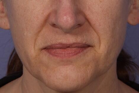 Injectable Fillers Before & After Image