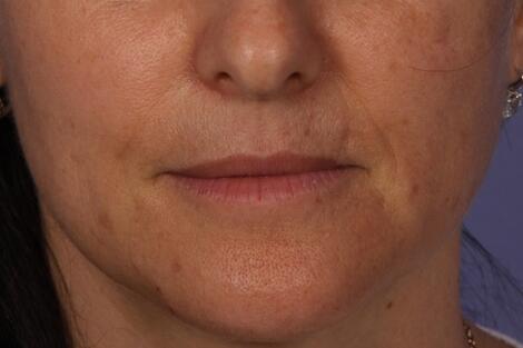 Injectable Fillers Before & After Image