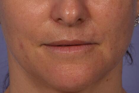 Injectable Fillers Before & After Image