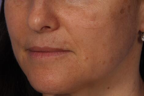 Injectable Fillers Before & After Image