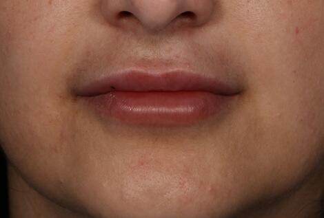 Injectable Fillers Before & After Image