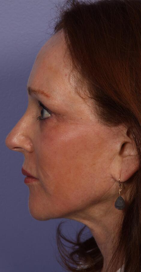 Injectable Fillers Before & After Image