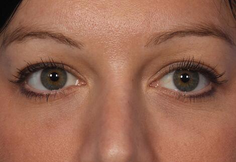 Injectable Fillers Before & After Image