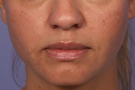 Injectable Fillers Before & After Image