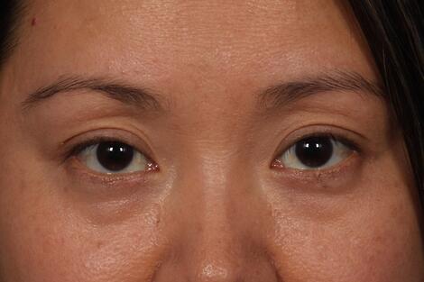 Injectable Fillers Before & After Image