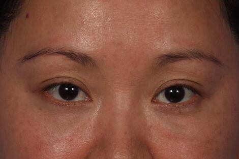 Injectable Fillers Before & After Image