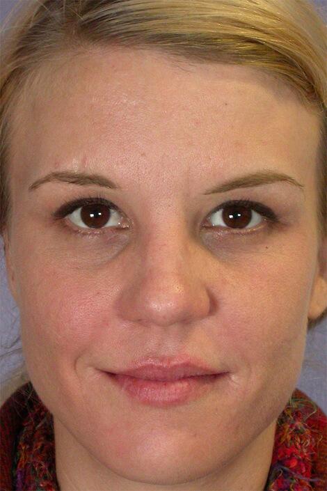 Injectable Fillers Before & After Image