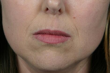 Injectable Fillers Before & After Image