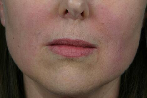 Injectable Fillers Before & After Image