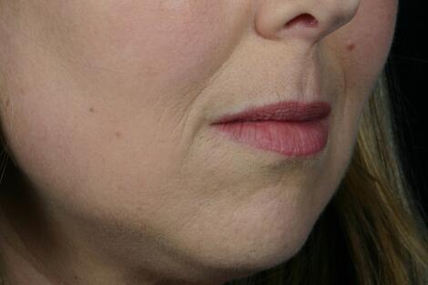 Injectable Fillers Before & After Image