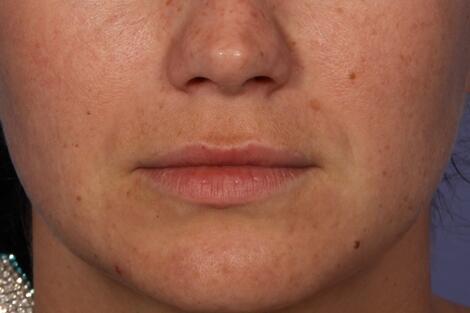 Injectable Fillers Before & After Image