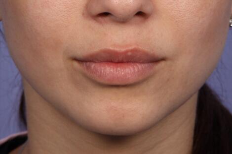 Injectable Fillers Before & After Image