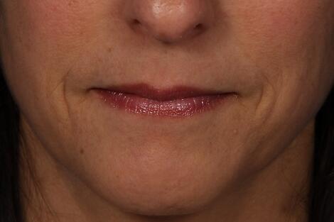 Injectable Fillers Before & After Image