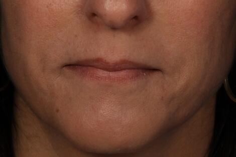 Injectable Fillers Before & After Image